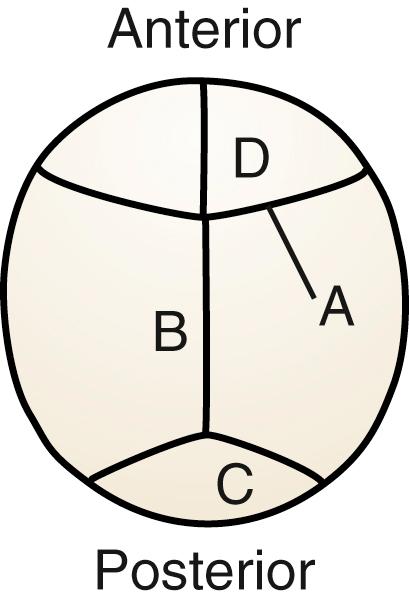 Fig. 23.2, Cranial sutures as viewed from the vertex of the skull. A, Coronal; B, sagittal; C, lambdoidal; D, metopic.