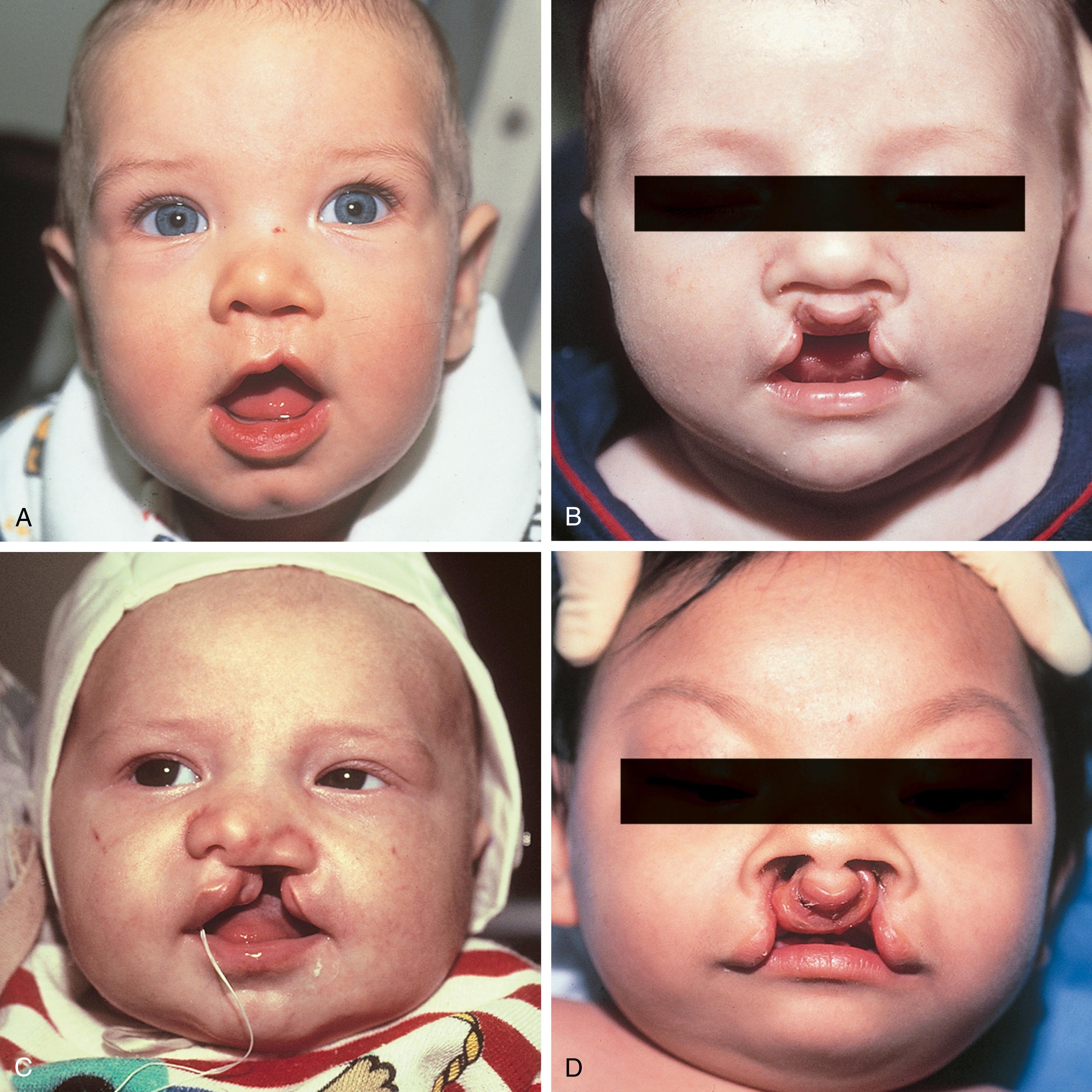 Fig. 23.3, The spectrum of lip clefting. (A) Left-sided unilateral cleft lip with minimal soft tissue involvement or “forme fruste.” (B) Incomplete bilateral cleft lip. (C) Complete left-sided unilateral cleft lip. Note the associated nasal deformity. (D) Complete bilateral cleft lip with associated palatal clefting.