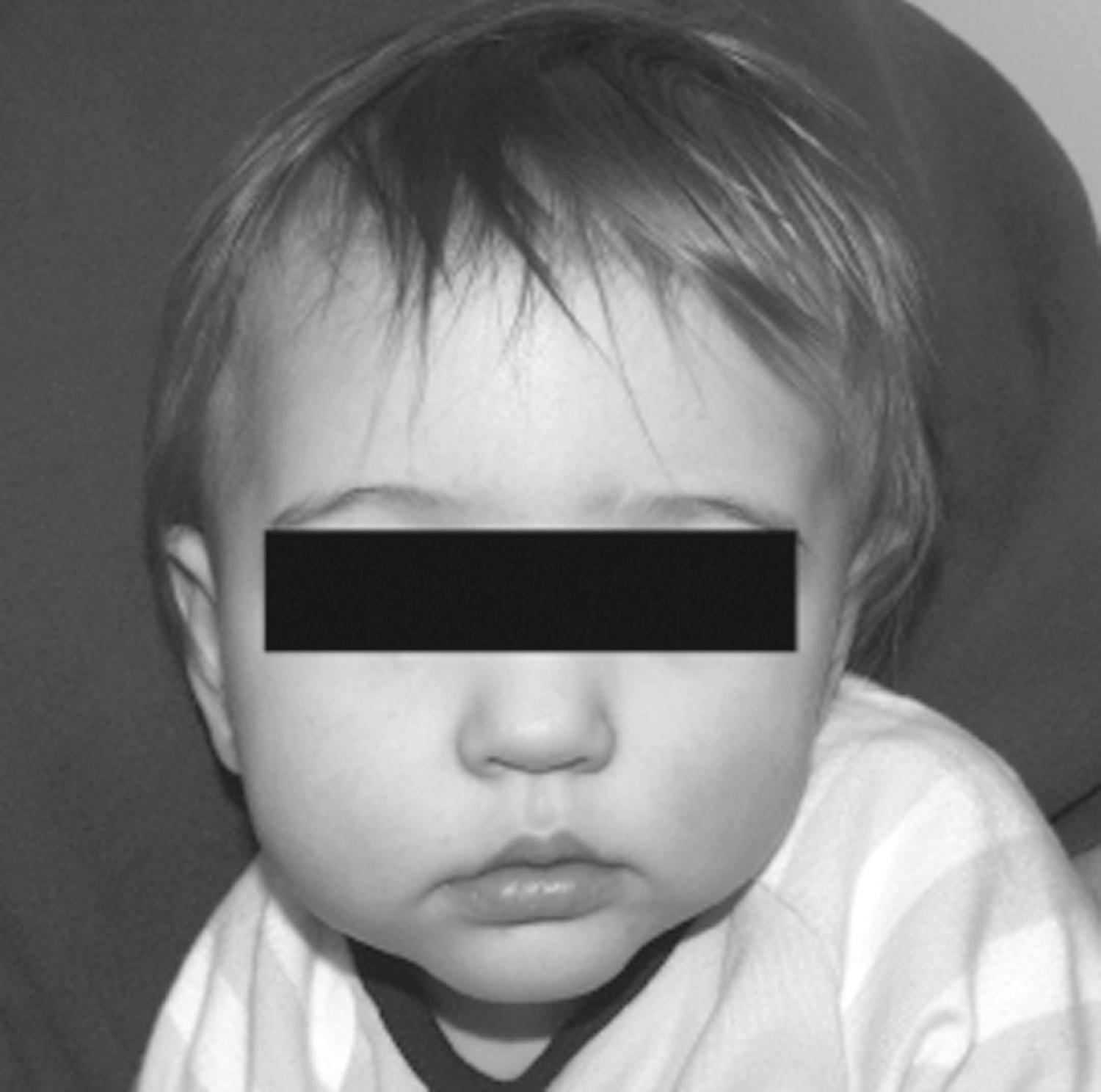 Fig. 23.4, Infant with right-sided deformational plagiocephaly demonstrating anterior craniofacial changes—an advanced forehead, ear, and cheek.