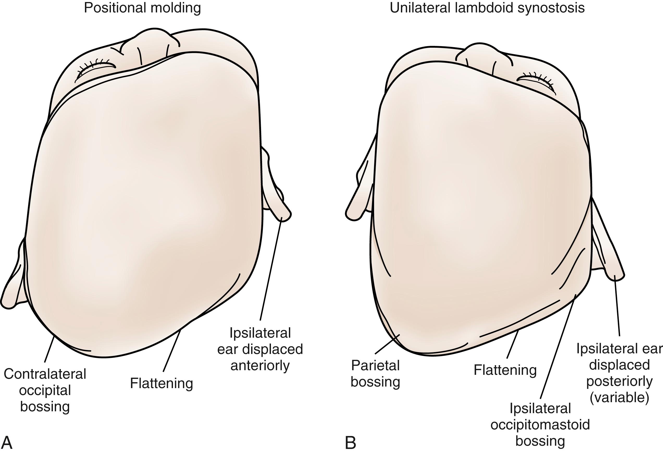 Fig. 23.5, Vertex views. (A) Right-sided deformational plagiocephaly exhibiting a parallelogram head shape. (B) Right-sided lambdoid craniosynostosis exhibiting a trapezoid-like head shape.