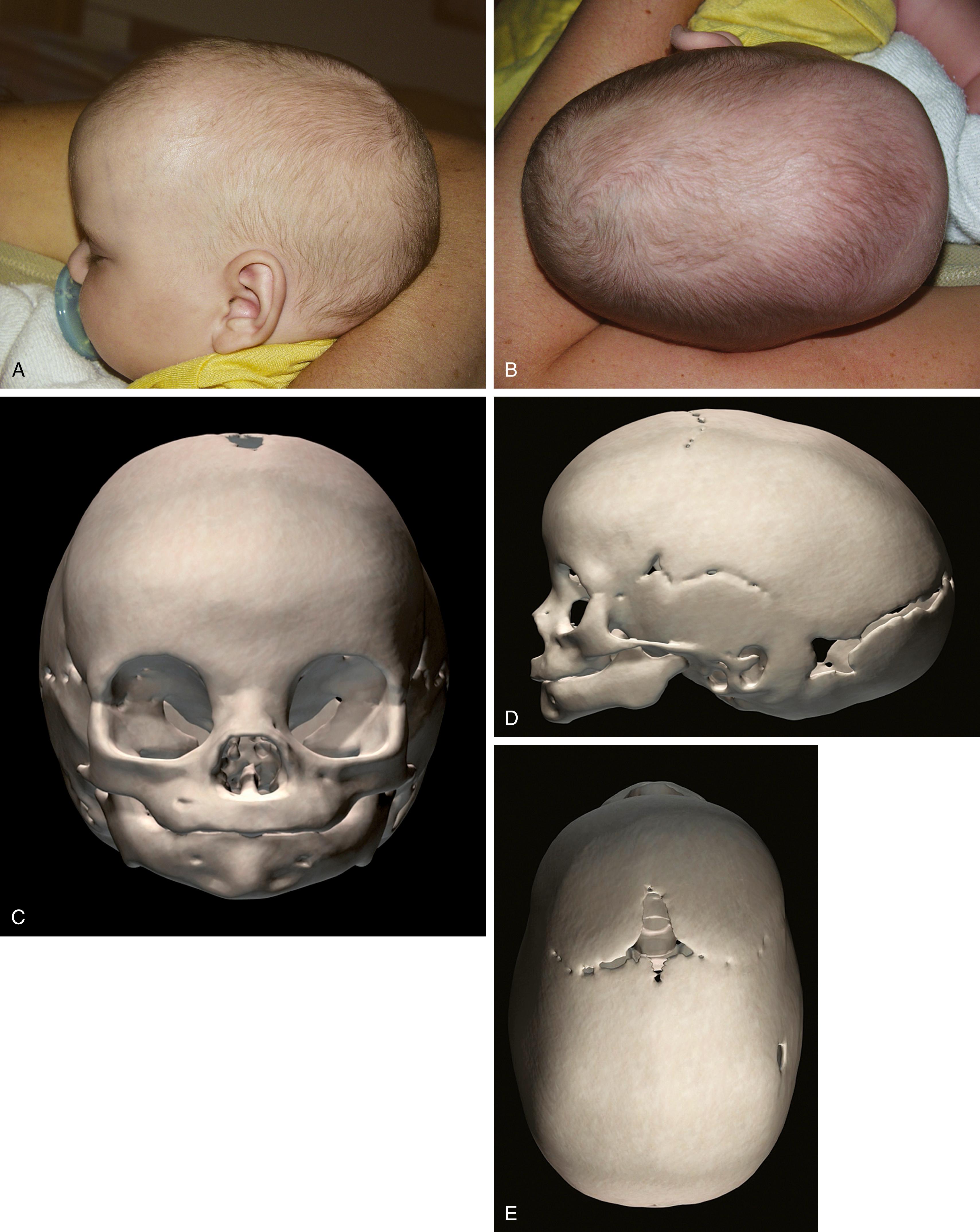 Fig. 23.6, Sagittal synostosis. Lateral (A) and vertex (B) views of a child with sagittal synostosis. Anterior (C), lateral (D), and vertex (E) views of the craniofacial skeleton of a child with sagittal synostosis.