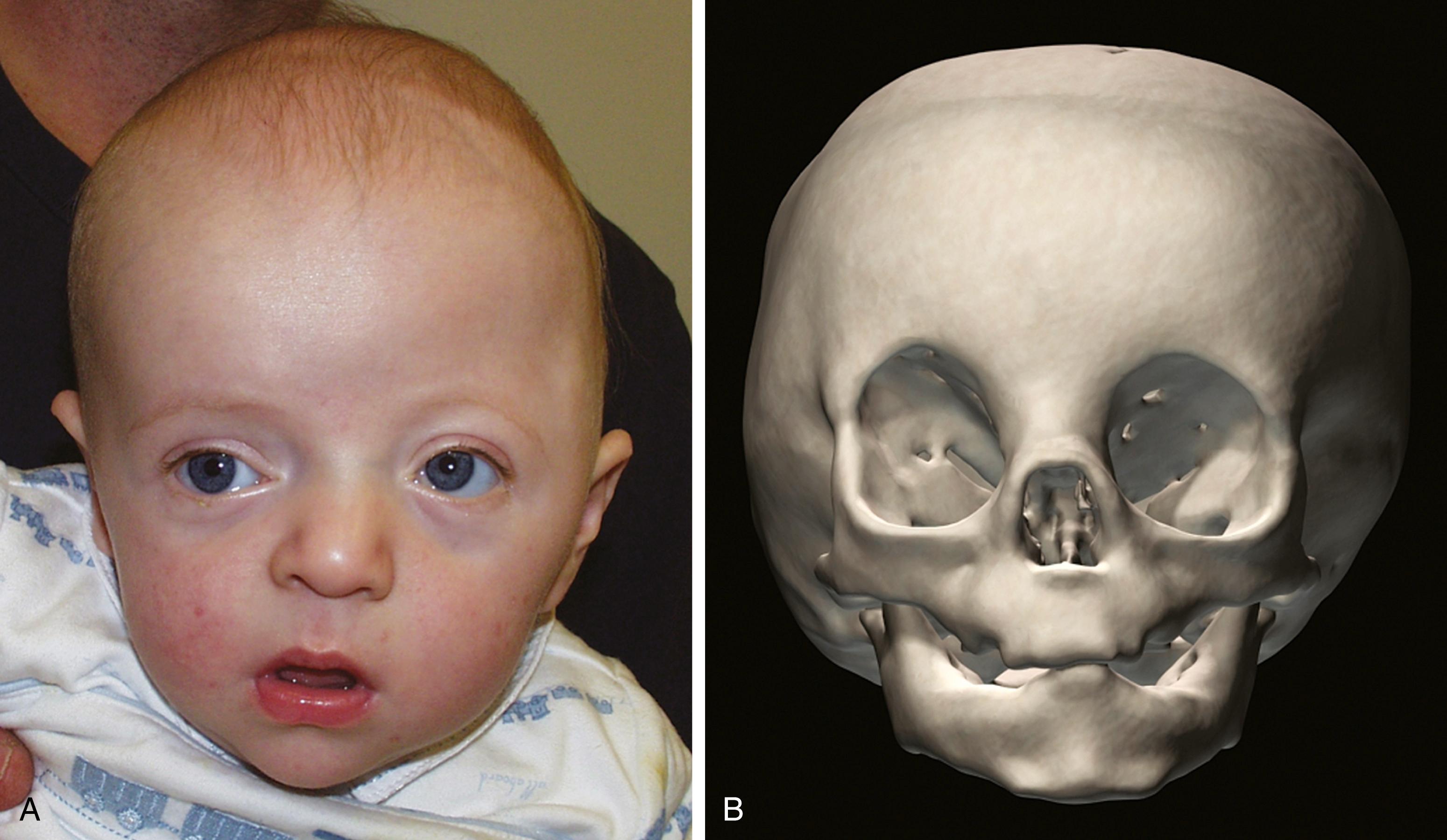 Fig. 23.8, Unilateral coronal synostosis. (A) Photograph of a child with left-sided unilateral coronal synostosis. (B) Anterior view of the craniofacial skeleton of a child with right-sided unilateral coronal synostosis.