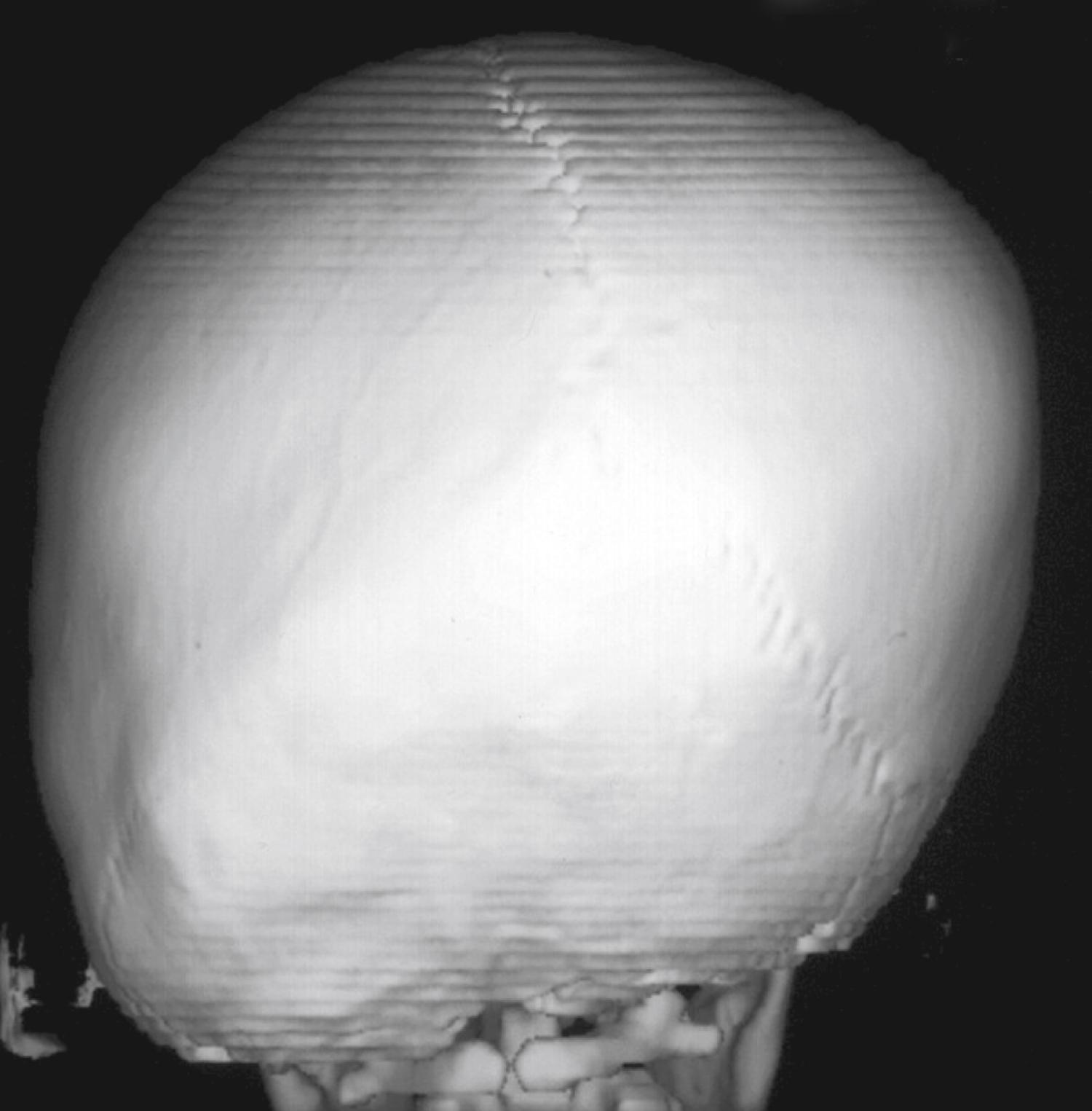 Fig. 23.9, Lambdoid synostosis. Posterior view of the craniofacial skeleton of a child with left-sided lambdoid synostosis.