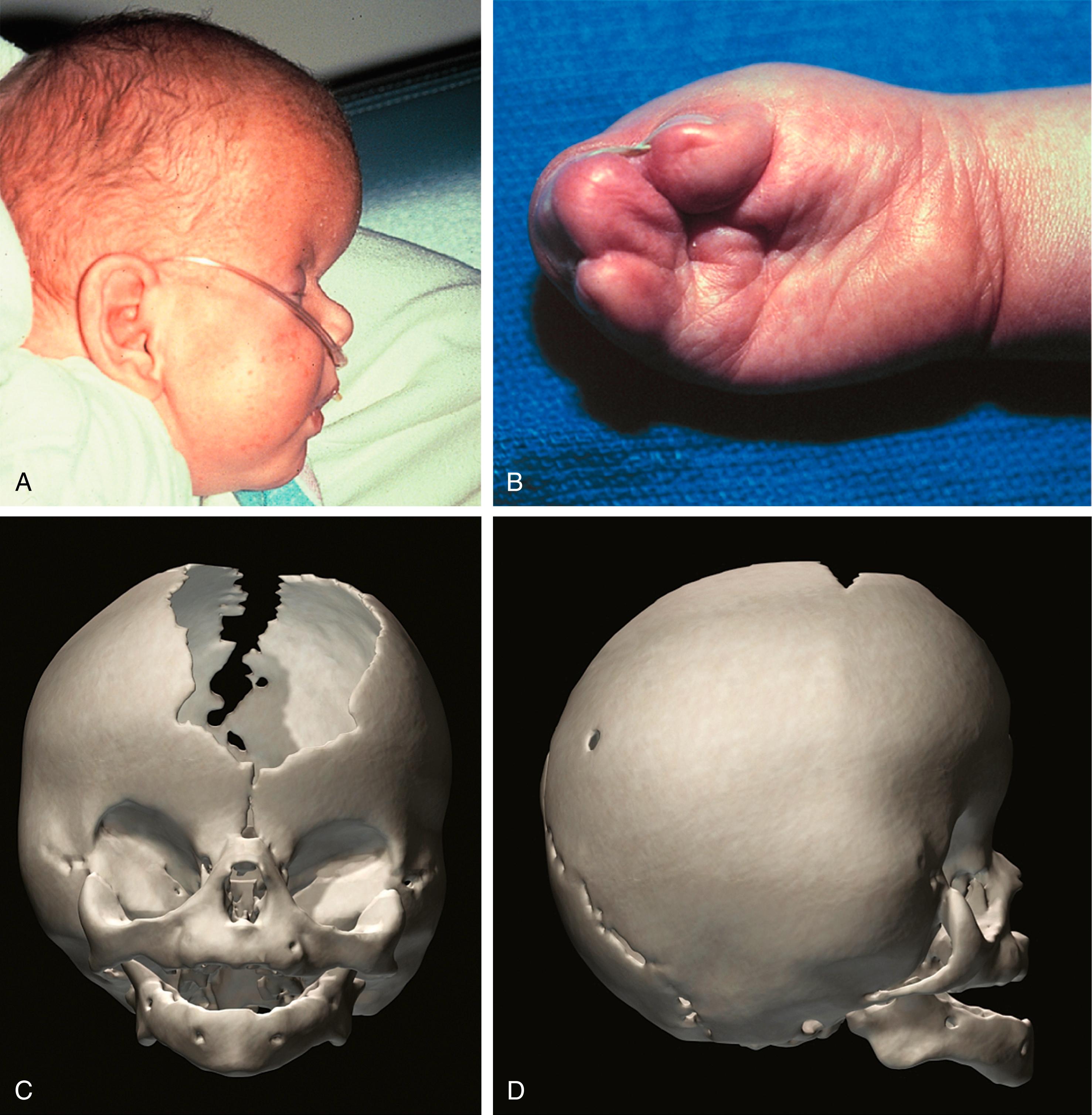 Fig. 23.10, Apert syndrome. (A) Lateral view of a child with Apert syndrome. (B) Syndactyly of the hand. Anterior (C) and lateral (D) views of the craniofacial skeleton of a child with Apert syndrome. Note the expansive anterior fontanelle in the anteroposterior view.