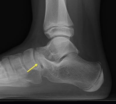 Fig. 27.1, Lateral weight-bearing radiograph of the right ankle in a 9-year-old girl with a calcaneonavicular coalition, demonstrating the “anteater nose sign” ( arrow ). When her pain persisted after casting, she underwent excision with tendon interposition and had complete resolution of symptoms.