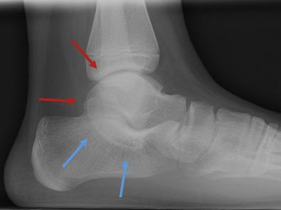 Fig. 27.2, Lateral weight-bearing radiograph of the left ankle in a 14-year-old male baseball player with hindfoot valgus and bilateral talocalcaneal coalitions, demonstrating the “C sign” formed by the posterior border of the sustentaculum tali ( blue arrows ) and the medial border of the talar dome ( red arrows ). Symptoms resolved with coalition resection with fat interposition and calcaneal slide osteotomy.