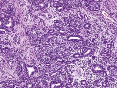 Figure 55-1, Wilms tumor, favorable histology, triphasic pattern.