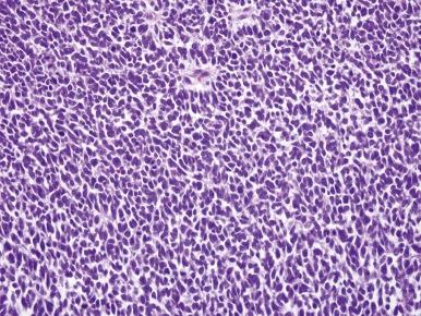 Figure 55-2, Wilms tumor, favorable histology, diffuse blastemal pattern.