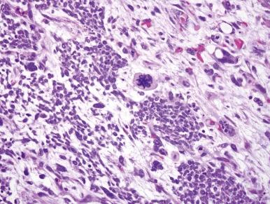 Figure 55-3, Wilms tumor, anaplastic.