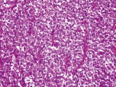 Figure 55-4, Clear cell sarcoma of the kidney.