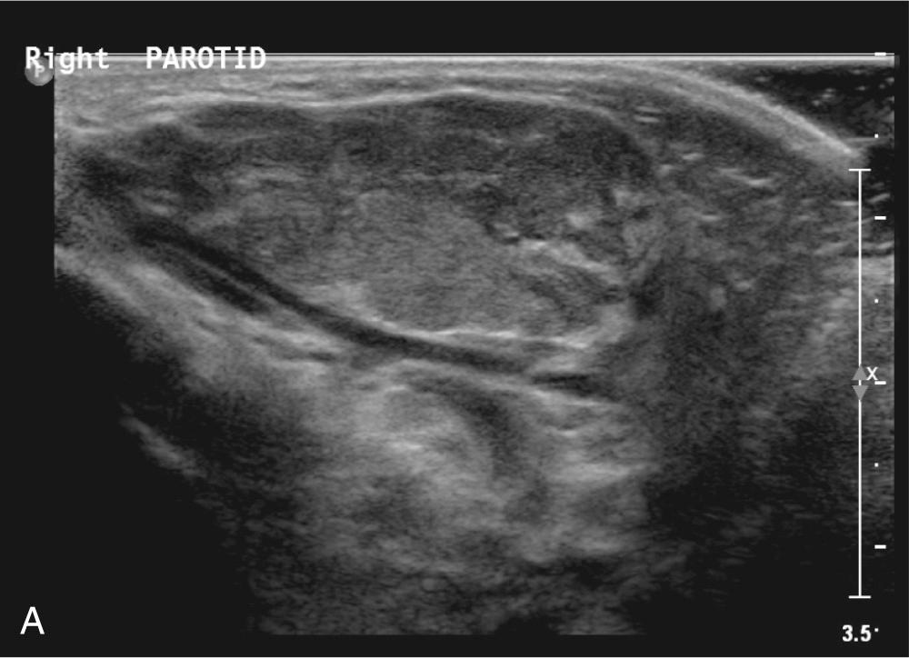 Fig. 8.1.1, (A) Ultrasound scan of a parotid hemangioma in a 1-year-old child. (B) Note the extensive cavernous vessels.