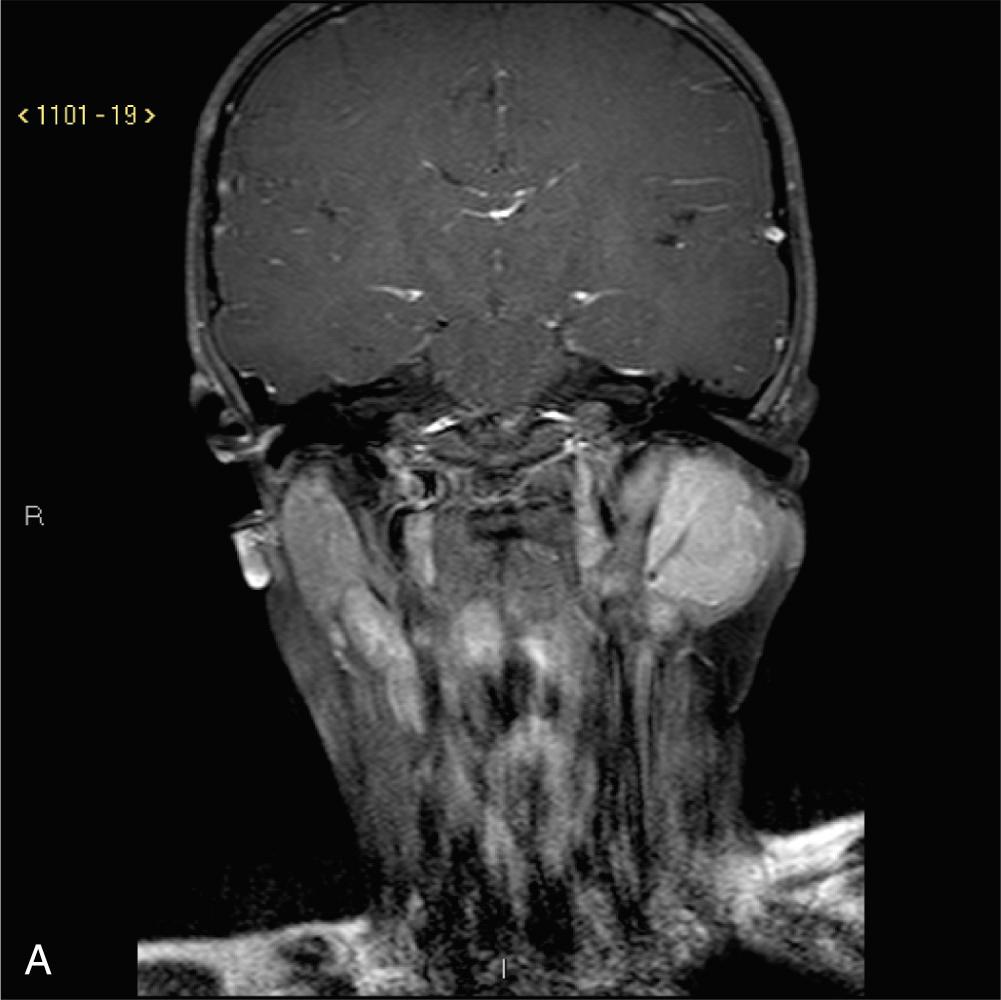 Fig. 8.1.3, Rhabdomyosarcoma (RMS) involving the parotid gland. Post-gadolinium image. (A) Coronal view. (B) Axial view.