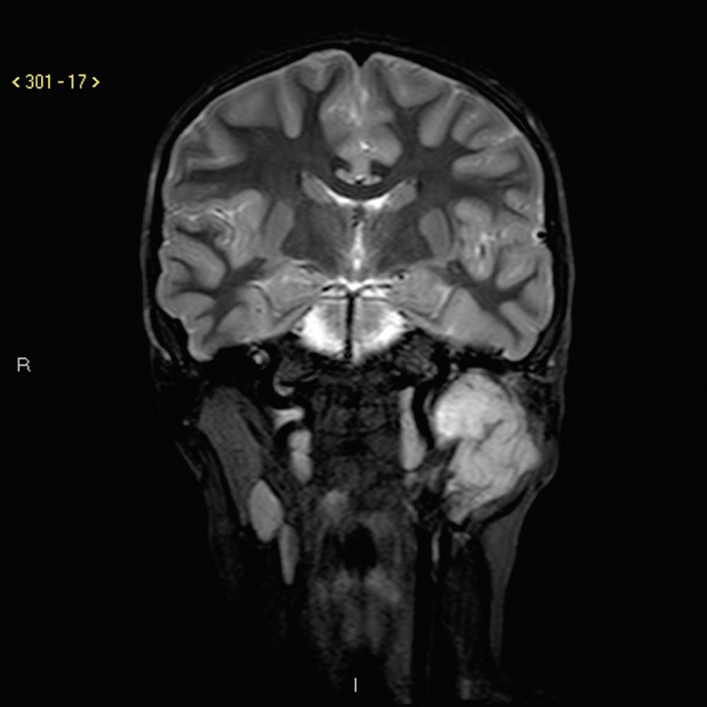 Fig. 8.1.4, Rhabdomyosarcoma (RMS) parotid gland. MRI image, STIR sequence.