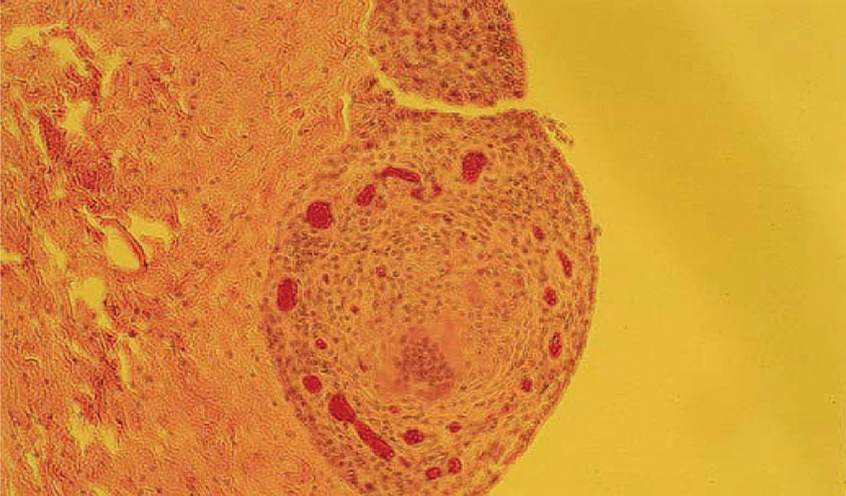 Fig. 41.2, Synovial biopsy showing a typical noncaseating epithelioid cell granuloma with multinucleated giant cells.