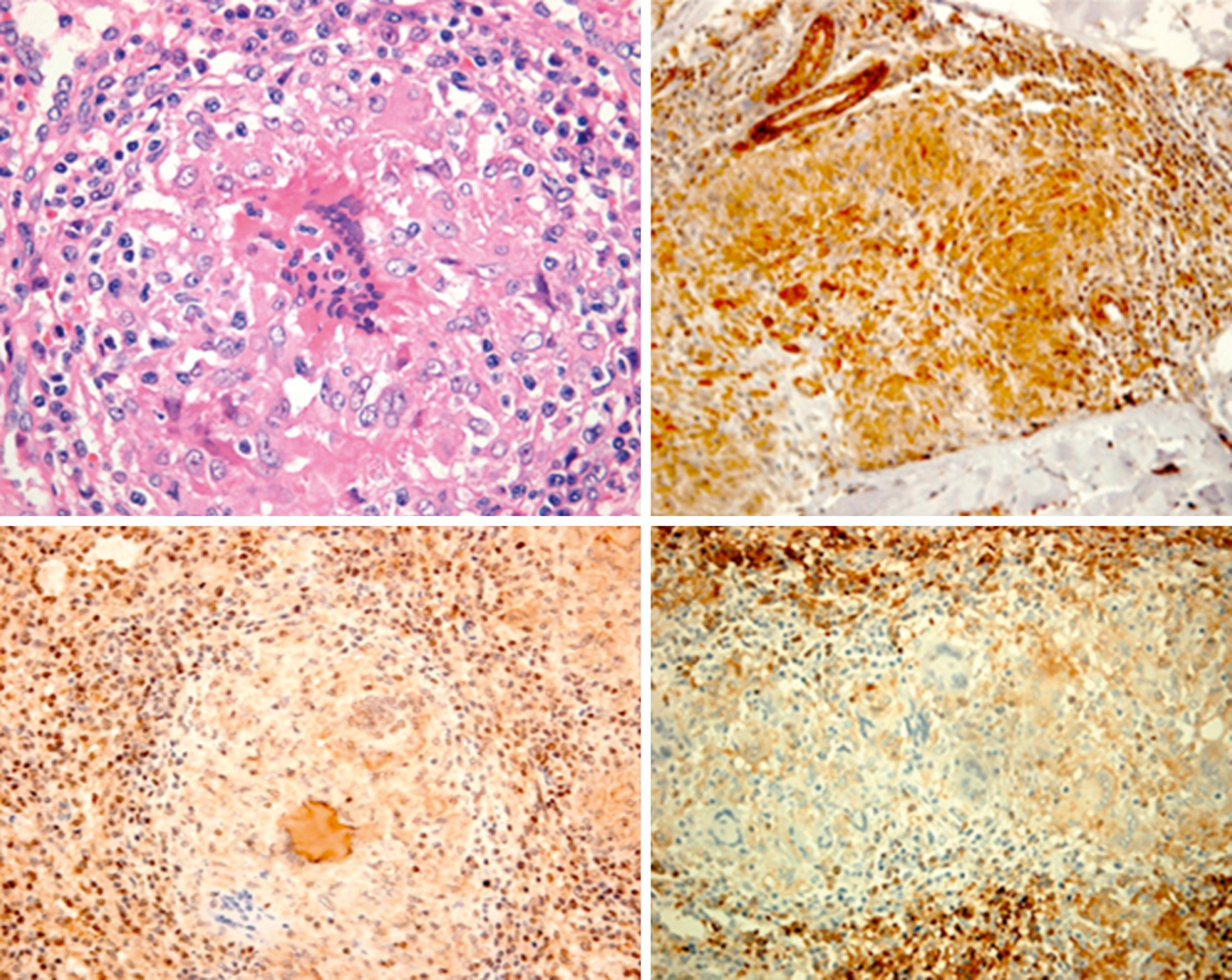 Fig. 41.3, Morphological and immunohistochemical characteristics of Blau granulomas, in clockwise appearance ( top left ). H&E staining showing prominent lymphocyte corona, emperipoletic lymphocytes, and multinucleated giant cell (MGC) death with fragmented cytoplasm and pyknotic nuclei. Using immunohistochemistry, dense staining was observed for IFN-γ ( top right ), IL-6 ( bottom left ), and IL-17 ( bottom right ).