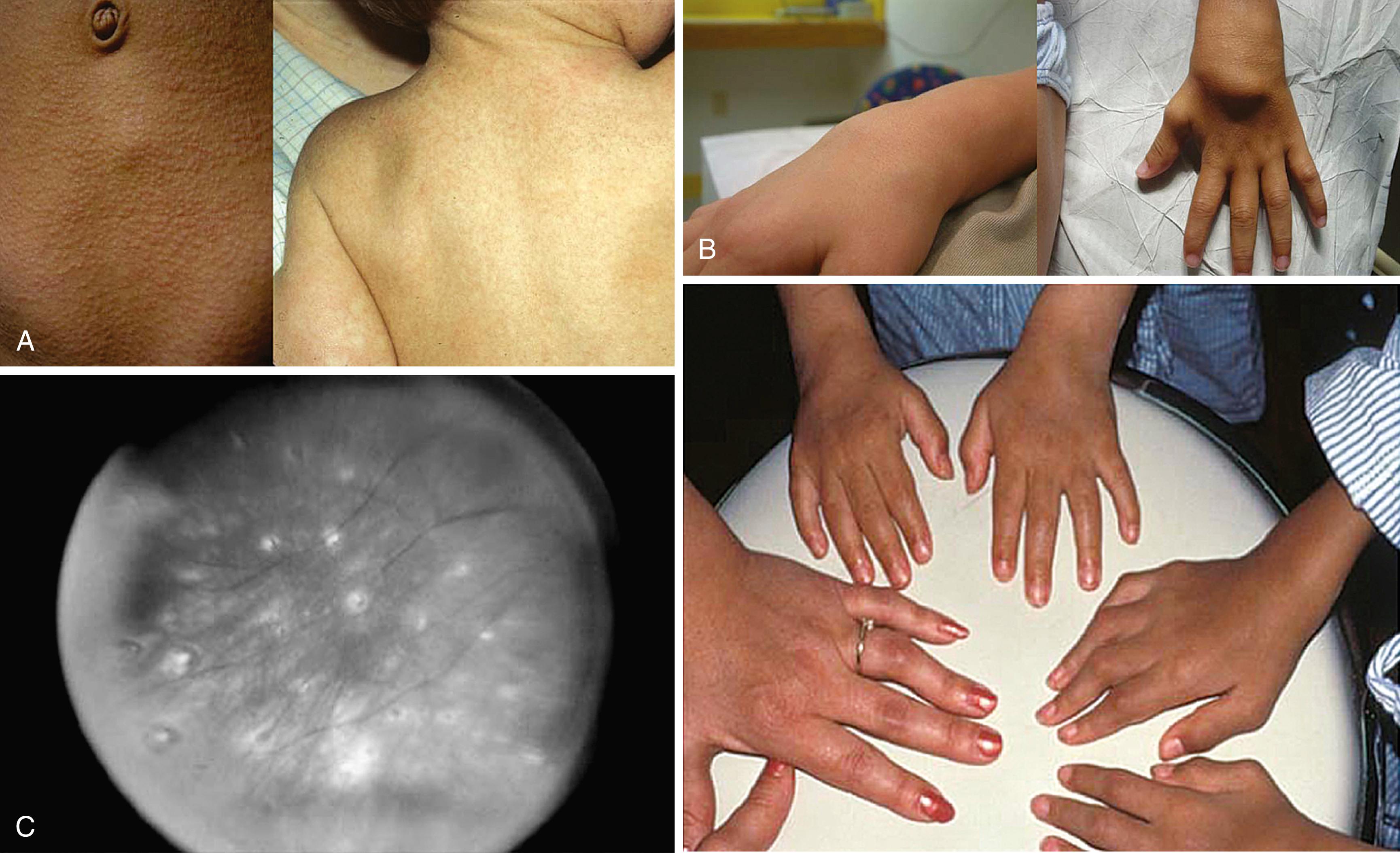 Fig. 41.4, Clinical triad typical of NOD2- associated pediatric sarcoidosis. A, Cutaneous features with fine maculopapular erythematous/tan eruption with ichthyosiform appearance (right). B, Typical “boggy” synovitis with preserved range of motion and cyst-like synovial swelling. Below, a family with NOD2 -associated polyarthritis and proximal interphalangeal (PIP) contractures causing camptodactyly. C, Multifocal choroiditis characteristic of granulomatous panuveitis.