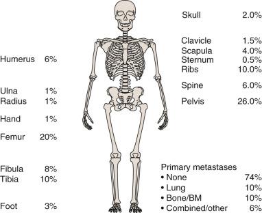 Fig. 80.1, Distribution of Primary Sites and Sites of Metastases in Ewing Sarcoma.