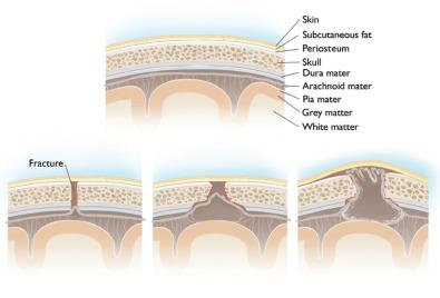 Fig. 2.1.2, Growing skull fracture. After injury and fracture, the arachnoid membrane will herniate into the fracture site and over time a leptomeningeal cyst will develop. The cyst communicates with the subarachnoid space but is contained by pia-arachnoid adhesions. As the cyst grows, it will erode away the underlying bone and begin to cause a noticeable deformity. The leptomeningeal cyst may become clinically apparent a year after the inciting injury.