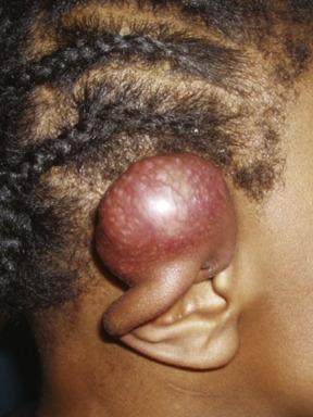 Fig. 79.1, Rhabdomyosarcoma of the Pinna of the Ear Presenting as a Painless Soft-Tissue Mass.