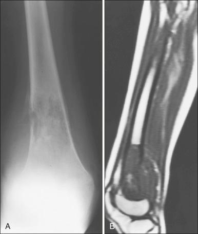 Figure 92.1, Osteosarcoma involving the right distal femur. (A) Plain radiograph shows a poorly defined, permeative destructive pattern, periosteal reaction, a Codman triangle, and an associated soft tissue mass. (B) Sagittal T2-weighted magnetic resonance image from the same patient shows abnormally dark area (representing increased signal intensity) in the intramedullary space consistent with tumor involvement by osteosarcoma. The associated posterior soft tissue mass is evident. Areas of bright focal signal enhancement represent intramedullary hemorrhage.