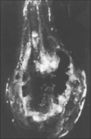 Figure 92.2, Dynamic, paramagnetic, contrast-enhanced magnetic resonance image from a patient with an osteosarcoma of the distal right lower extremity. At subsequent pathologic examination, the focal areas of increased signal intensity were found to represent nests of viable tumor.