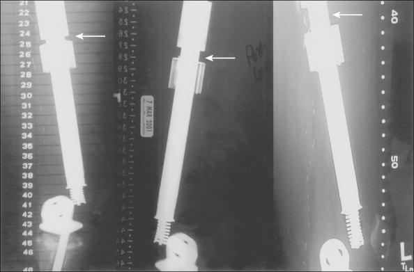 Figure 92.4, Radiographs show the expandable portion of the Phenix (Repiphysis) device. The titanium tubular portion expands out of the polymeric tube. The increased distance between barrel and stem indicates the amount of expansion that occurred (arrows).