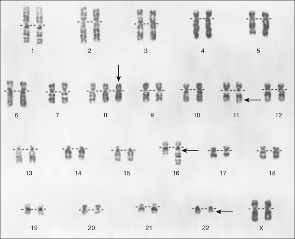 Figure 92.5, Karyotype obtained from a Ewing sarcoma tissue specimen shows the characteristic t(11;22) (q24;q12), secondary t(1;16)(q21;q13), and trisomy 8.