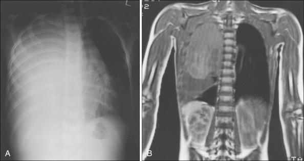 Figure 92.6, Primitive neuroectodermal tumor involving the chest wall. (A) Plain radiograph shows complete opacification of the right hemithorax, marked mediastinal shift, and slight tracheal narrowing. (B) Coronal T1-weighted magnetic resonance image shows a large right intrathoracic mass with subjacent pleural effusion and small localized area of normal aerated lung parenchyma.