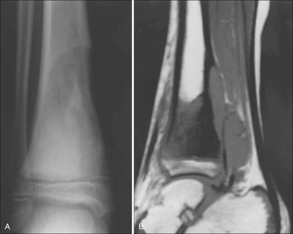 Figure 92.7, Ewing sarcoma of the right distal tibia. (A) Plain radiograph shows a poorly marginated destructive lesion with associated periosteal reaction. (B) Sagittal T1-weighted magnetic resonance image of the same lesion shows a well-demarcated dark area of low signal intensity defining the intramedullary extent of the tumor contrasted against the bright appearance of the high signal intensity derived from intramedullary fat. The soft tissue component of the tumor is evident in the posterior aspect.