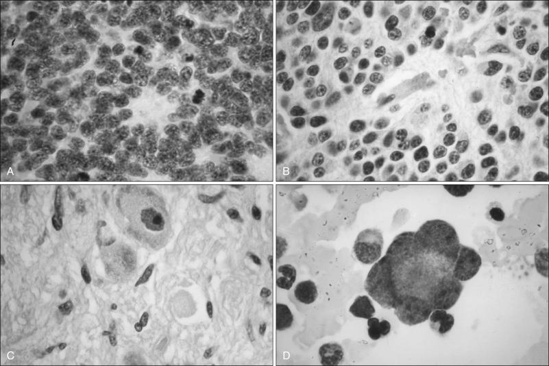 Figure 92.8, (A) Neuroblastoma with nest of dense primitive cells surrounding a fibrillar center. (B) Ganglioneuroblastoma consisting of primitive cells but with increased amounts of fibrillar material. (C) Ganglioneuroma with well-differentiated ganglion cells, Schwann cells, and nerve bundles. (D) Bone marrow involvement with metastatic neuroblastoma forming a pseudorosette.