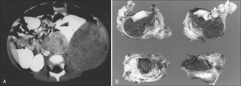 Figure 92.10, (A) Computed tomography scan shows adrenal neuroblastoma at diagnosis. (B) Serial sections through a resected adrenal neuroblastoma show large areas of diffuse hemorrhage and calcification.