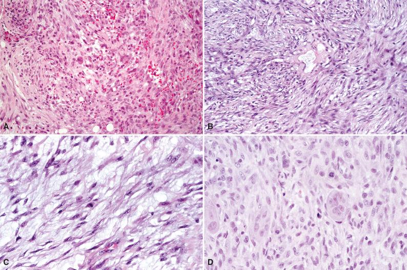 Figure 4.1, Nodular Fasciitis.