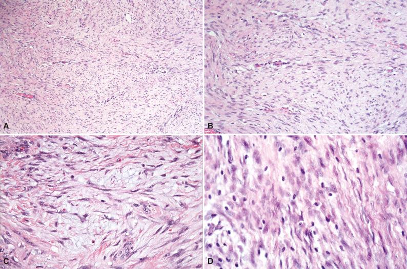 Figure 4.13, Desmoid Fibromatosis.