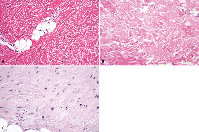 Figure 4.3, Gardner Fibroma.