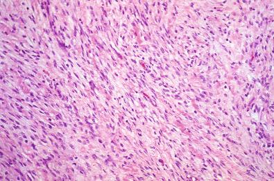 Figure 4.6, Cardiac Fibroma.