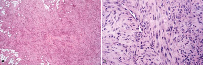 Figure 4.9, Infantile Myofibroma.