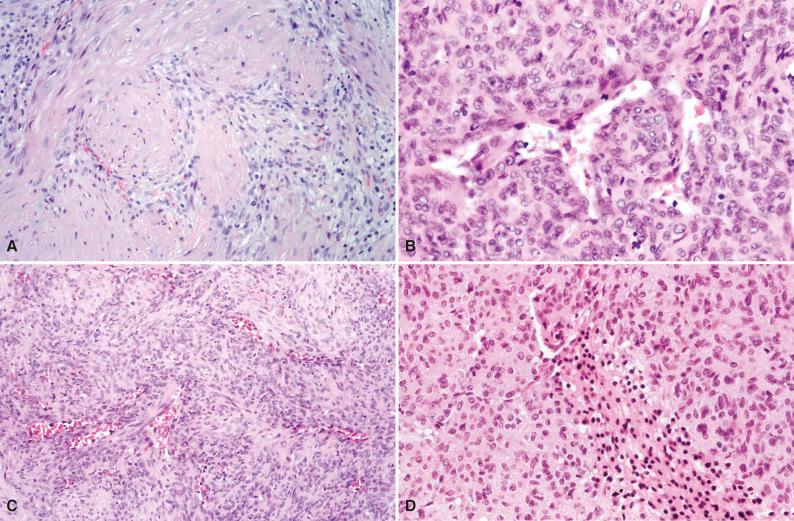 Figure 4.10, Infantile Myofibroma.