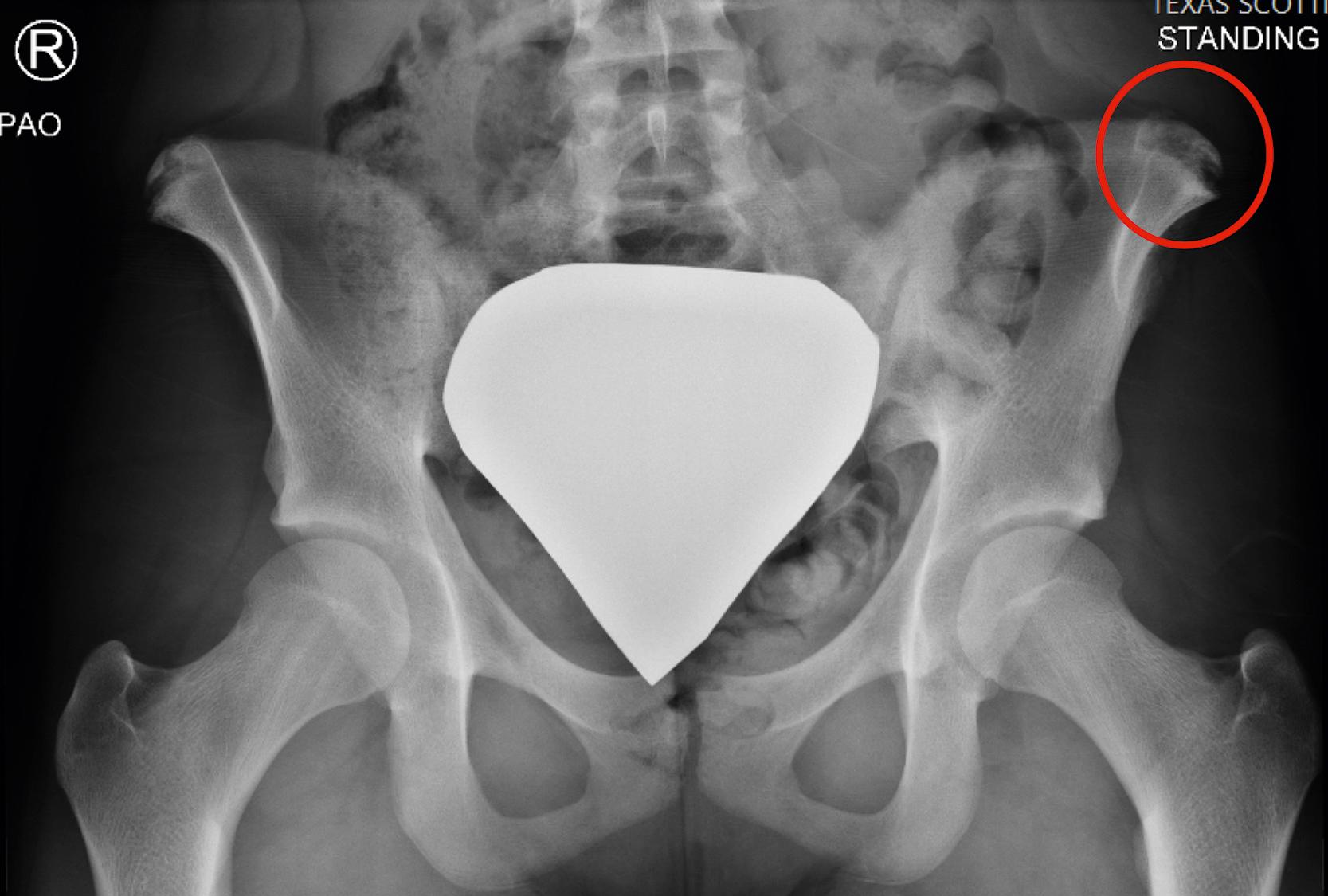 Fig. 40.10, Anteroposterior pelvis of a 15-year-old female runner with tenderness of palpation over the left anterior superior iliac spine (ASIS). Red circle outlines the irregularity of the secondary ossification center at the origin of the sartorius consistent with radiographic apophysitis of the ASIS.