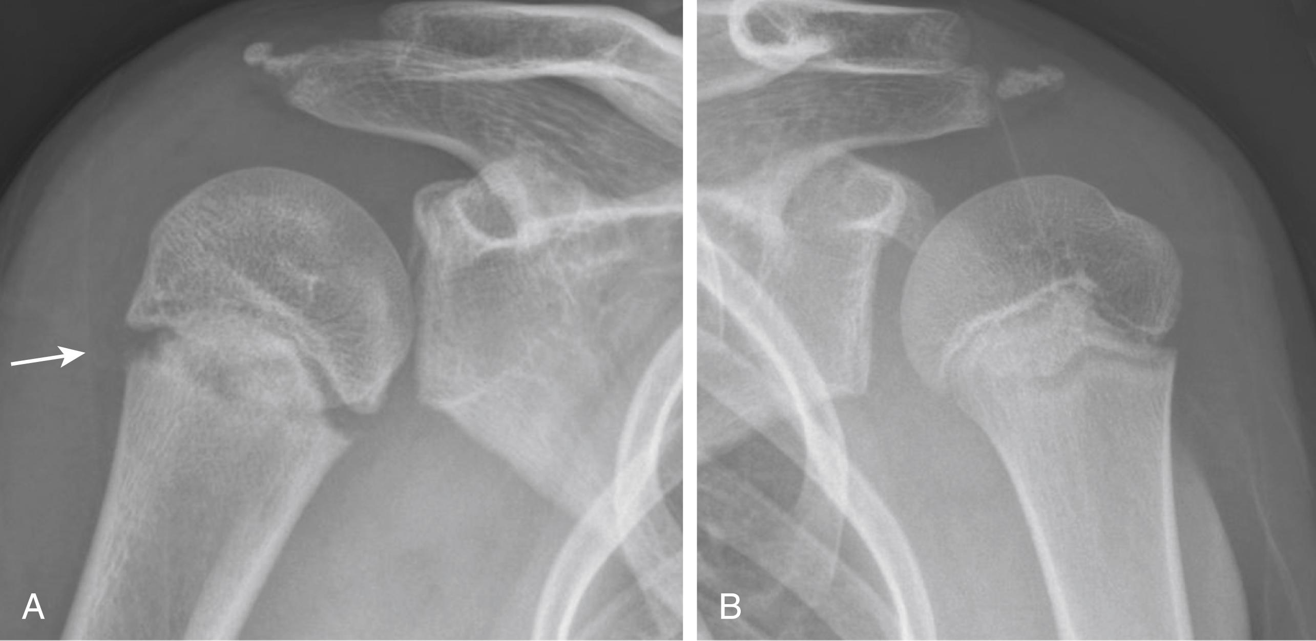 Fig. 40.4, (A) Arrow showing widening of the proximal humeral physis, right shoulder. (B) Note comparison of normal view of the left shoulder.