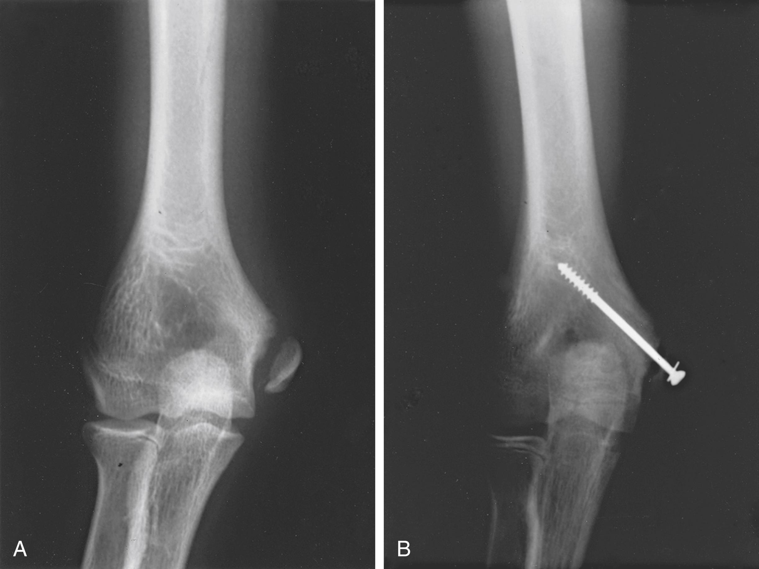 Fig. 40.8, (A) Displaced medial epicondyle fracture in a 14-year-old Little League pitcher. The injury was sustained during pitching. (B) Anteroposterior radiograph obtained after open reduction and fixation of the medial epicondyle fragment.