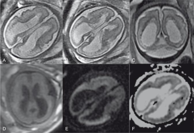 e-Figure 37.1, Fetal infarct.