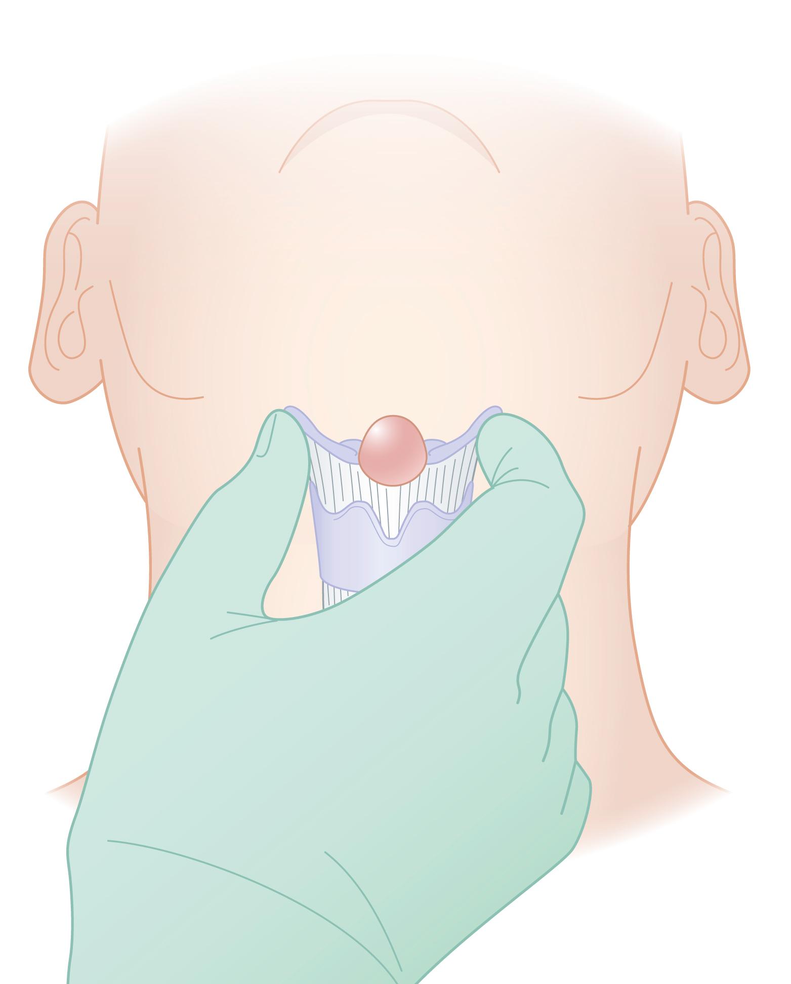 Fig. 67.1, Thyroglossal duct cyst presents as a midline neck mass. Thyroglossal duct cyst can extend up to its origin at the foramen cecum.