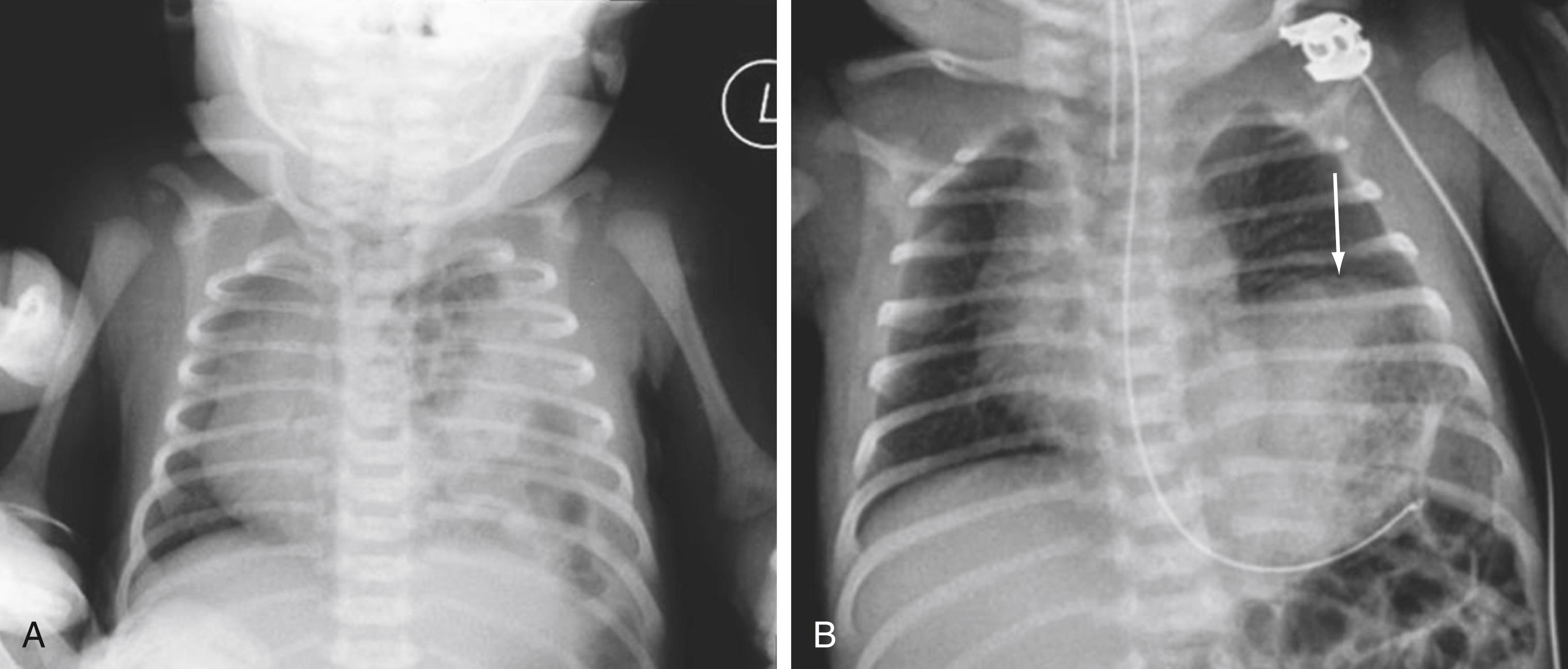 Fig. 67.2, (A) Congenital diaphragmatic hernia. Multiple gas-filled bowel loops are located in the left hemithorax, and the mediastinum is shifted to the right. (B) Left diaphragmatic eventration. Hemidiaphragm is elevated (arrow) from phrenic nerve injury-induced paralysis.