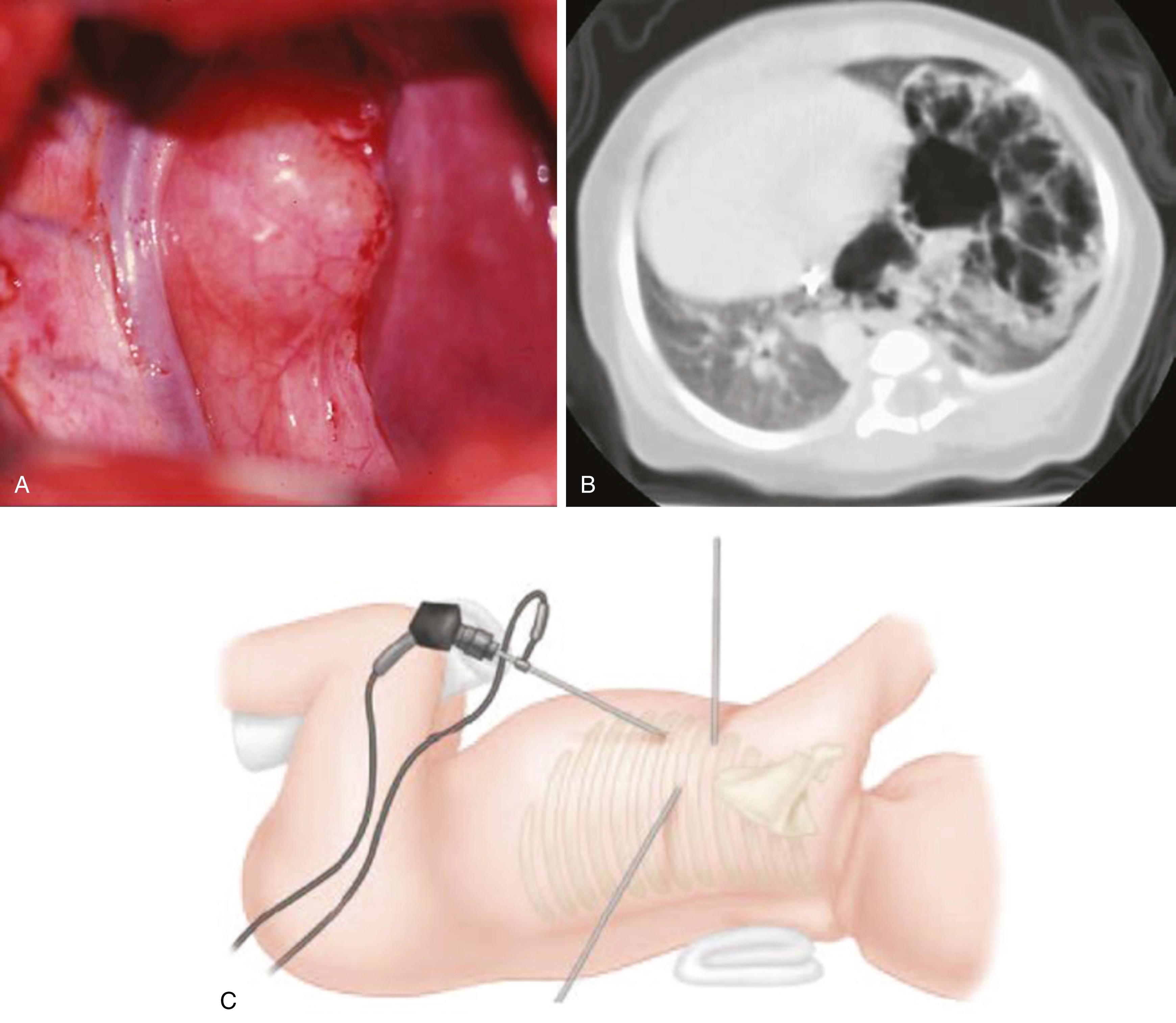 Fig. 67.3, (A) Thoracoscopic view of a bronchogenic cyst. (B) Computed tomography scan demonstrating a large left lung congenital pulmonary airway malformation lesion. (C) Cartoon depiction of a set up for thoracoscopic surgery in an infant. The use of a 3-mm thoracoscope, 3-mm vessel sealer, and a 5-mm stapling device have contributed to more efficient and safer lobectomies.