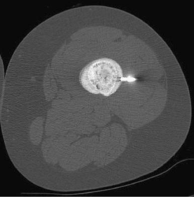 Figure 49-12, Core needle biopsy of an osteosarcoma of the femur under guidance with computed tomography.
