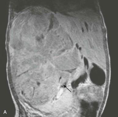 Figure 49-14, A , Magnetic resonance imaging (MRI) scan of a 2 and a half-year-old girl first seen with a massive right-sided abdominal mass (arrow) that appeared to arise from the kidney. Chest radiograph revealed pulmonary nodules as well as stage-IV disease. Because of the size of the primary tumor and the presence of metastatic disease, she received neoadjuvant chemotherapy after needle biopsy demonstrated a standard-risk tumor (diffuse blastemal subtype). She first received three courses of actinomycin D, vincristine, and cyclophosphamide, which achieved some shrinkage of the tumor. At attempted resection, the extensive tumor was densely adherent to the posterior aspect of the liver and the vena cava. The attempted resection was halted at that time, because it was clear that a portion of the liver would have to be resected with the nephrectomy. Repeat biopsies again demonstrated a standard histology Wilms tumor with tumor invasion into the liver. She then received more intensive therapy involving cisplatin and VP-16, as well as abdominal and thoracic radiation. B , MRI after additional therapy showed remarkable shrinkage of the tumor, allowing a less extensive and safer resection. A plane could be developed between the liver and kidney at this point, and hepatectomy was not required.