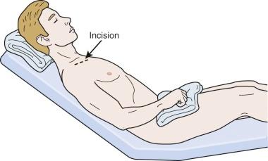 Figure 49-5, Proper position for patient with airway compromise to obtain a biopsy of an anterior mediastinal mass.