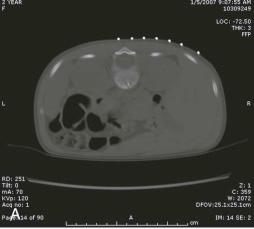 Figure 49-8, A , Prebiopsy computed tomography (CT) of a retroperitoneal mass with external grid for biopsy marking. B , The same patient with the needle in the retroperitoneal mass (arrow). C , Postbiopsy CT with air in the mass and soft tissues (arrow) from the biopsy procedure. D , Prebiopsy ultrasound of a liver mass. E , Ultrasound-guided biopsy of a liver mass (arrow). F , Postbiopsy hemorrhage in the mass is depicted (arrow).