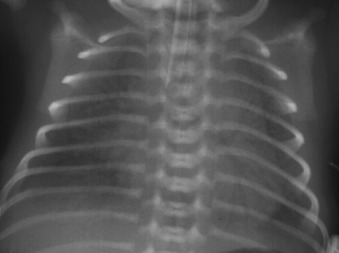 Figure 85-1, RDS on frontal chest radiograph. Note diffuse ground glass opacity in lungs and low lung volumes in this premature infant.