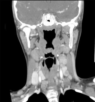 Fig. 29.1, Coronal computed tomography (CT) with contrast demonstrating bilateral, lateral, and central compartment lymph node metastases in an 11-year-old patient with diffuse sclerosing variant papillary thyroid cancer (DSVPTC).